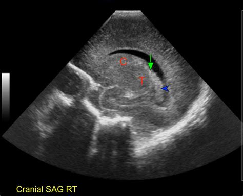 Normal Neonatal Brain Sonography Of A Preterm Newborn In Right Lateral