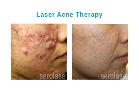 Nmac Laser Acne Therapy