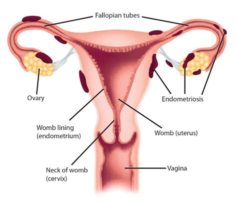 Bezakan pms (premenstrual syndrome) vs dysmenorrhea saintis pun tak tahu secara konklusif kenapa, tapi di percayai sakit atau rasa cramp itu berlaku kerana tindak balas prostaglandins di rahim. Ini Tanda-Tanda Anda Mungkin Hidap Endometriosis