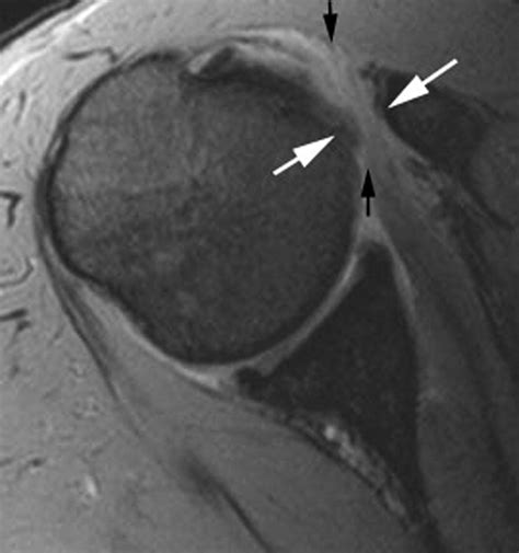 Mri Of Impingement Syndromes Of The Shoulder Clinical Radiology