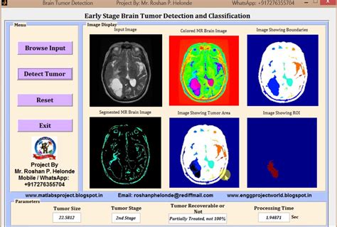 Brain Tumor Detection And Tumor Stage Classification Using Image