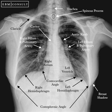 Depending on its density, each organ within the chest cavity absorbs varying degrees of radiation, producing different shadows on the film. Chest Xray (Radiograph) AP View Image | Radiology ...