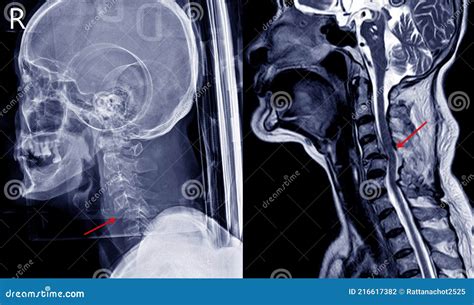 X Ray Image And Mri Of Cervical Spine Case Trauma Showing C45