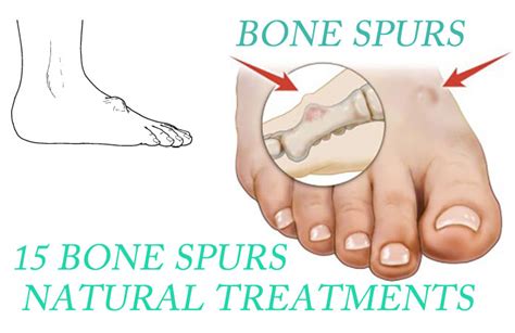 Other locations on the body where an individual might develop a bone spur. 15 Bone Spurs (Neck And Knee) Natural Treatments That Work