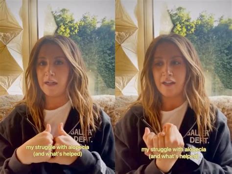 Ashley Tisdale Opens Up About Alopecia Struggle ‘its Nothing To Be