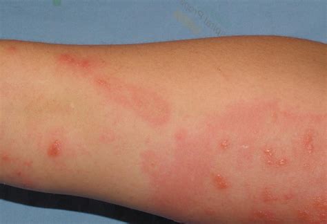 Rash On The Wrist Causes Diagnosis And Treatment