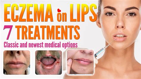 Eczema On Lips Treatment Options How To Treat Lip Eczema Around Mouth