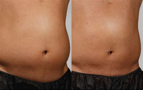 Sculpsure Before And After Photos Lightrx Face And Body