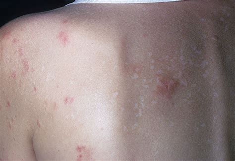 Dermatitis Herpetiformis Picture Hardin Md Super Site Sample
