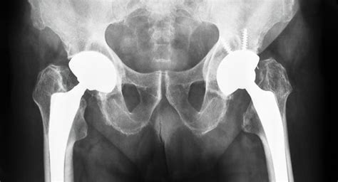 What Are The Cost Effective Implants In Hip Replacement Surgery