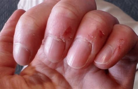 Skin Peeling On Fingers Near Nails Causes And Remedies