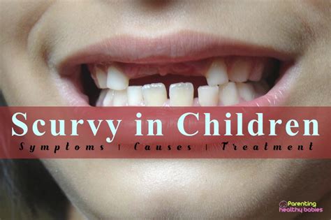 Scurvy In Children Symptoms Causes And Treatment