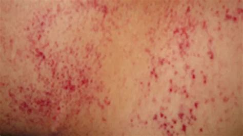 Petechiae Causes Treatments Pictures And More Chronic Fatigue