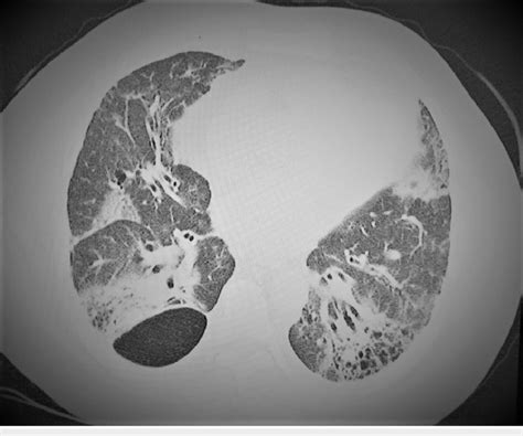 Chest Ct Scan Lung Parenchyma Window Showing Architectural Distortion