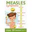 Measles Cases On The Rise Parents Know These Symptoms  Franciscan Health