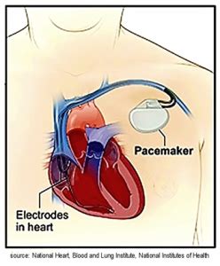 Icd vs pacemaker statistically, the number one killer is heart disease. Pacemakers & ICDs