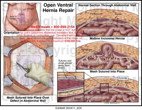 Medivisuals Open Ventral Hernia Repair Medical Illustration