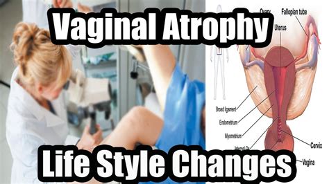 Lifestyle Changes For Treating Vaginal Atrophy Youtube
