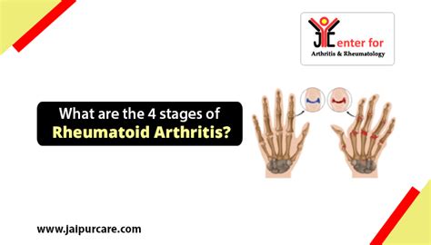What Are The 4 Stages Of Rheumatoid Arthritis Jaipurcare