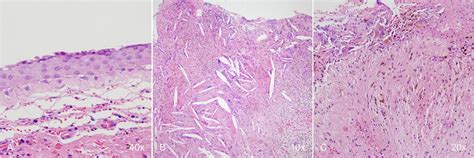 Histological Examination Of The Cyst Stratified Squamous Epithelial