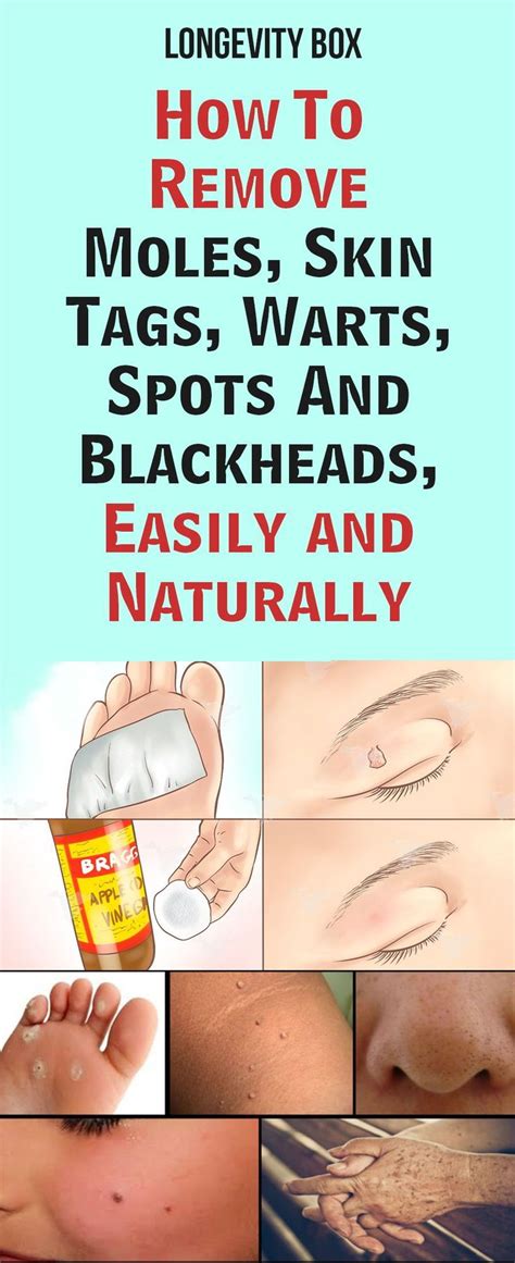 how to remove moles skin tags warts spots and blackheads easily and naturally