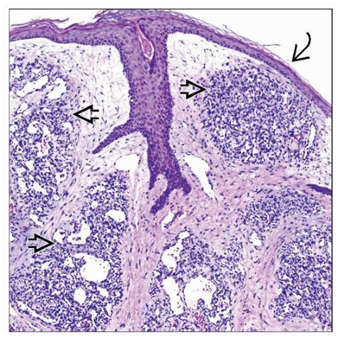 Capillary Venous And Cavernous Hemangiomas Basicmedical Key