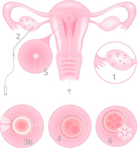 Assisted Reproduction Techniques In Vitro Fertilisation Ivf