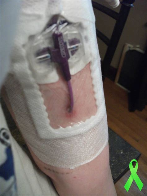 My Fight Against Lyme Disease Picc Line