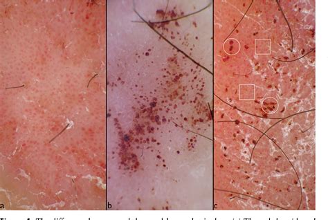 Figure 1 From Dermoscopic Hemorrhagic Dots An Early Predictor Of