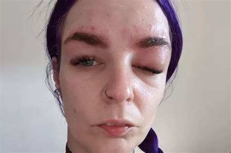 Mum Left Looking Like Quasimodo After Life Threatening Allergic Reaction To Eyebrow Tint