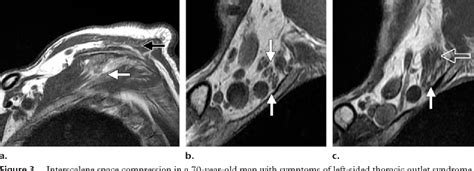 Figure 1 From Multimodality Imaging Of Peripheral Neuropathies Of The