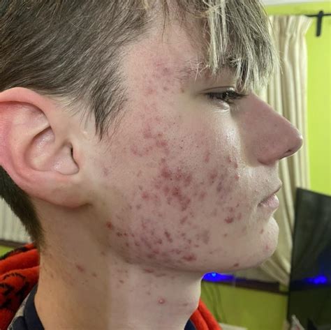 Acne Scars After Accutane Racnescars