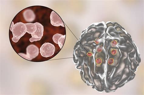 Cryptococcal Meningitis Medical Concept Stock Illustration