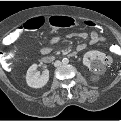 Abdominal Ct Scan Pre Operative Ct Scan Showing Incidental