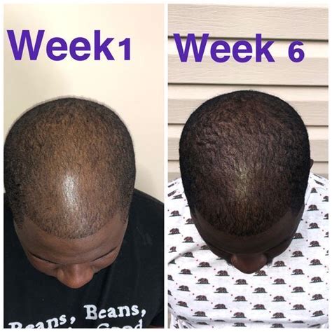37 HQ Photos Black Men Hair Loss : Amazon Com Instant Hair Loss