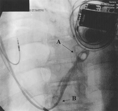 Balloon Dilatation Of Coronary Sinus Spasm During Placement Of A