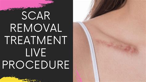 Dermabrasion For Scar Removal Live Surgery Scar Removal Treatment In