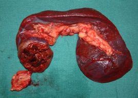 Before i talk about this, i want to quote dr marty goldstein. hemangiosarcoma+in+dogs | ... hemangiosarcoma. Metastasis ...