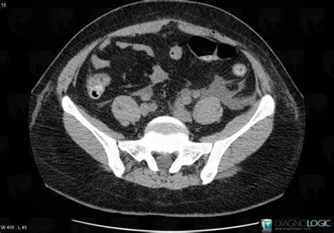 Radiology Case Urinoma Ct Diagnologic