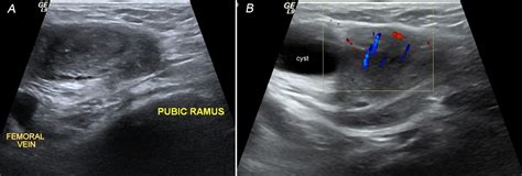 Case Report Incarcerated Femoral Hernia Containing Ovary Unusual Presentation Of Uncommon