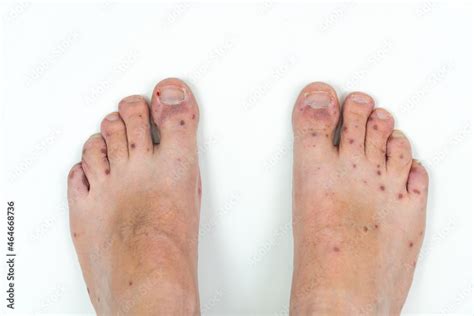 Human Legs With Dermatitis Allergy Rash Close Up Of Males Foot And
