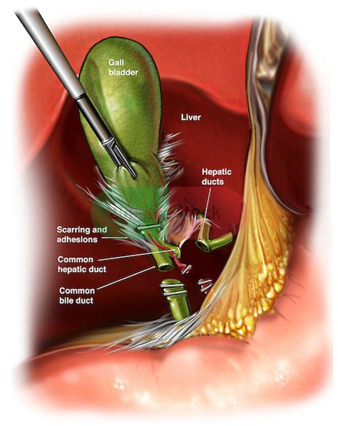 Common Bile Duct Surgery