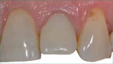 Foto preoperatoria. Necessità di sostituzione di elemento ...