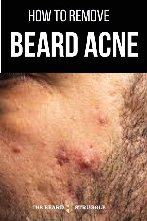 All You Need To Know About Beard Pimples And How To Eliminate Them Once