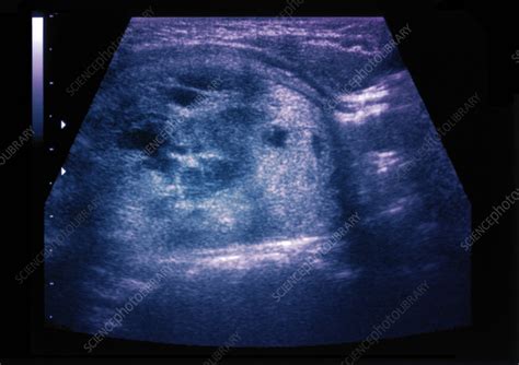 Thyroid Nodule Ultrasound Scan Stock Image C0552883 Science
