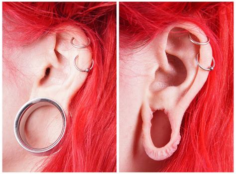 Corrective Ear Surgery For Stretched Lobes