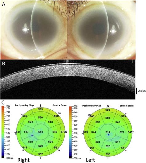 Astigmatism Diagrams Astigmatism Glaucoma Swollen Eyes Disease Fff