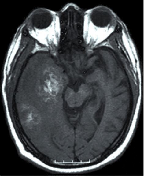 Tumor Malignant Brain Tumor