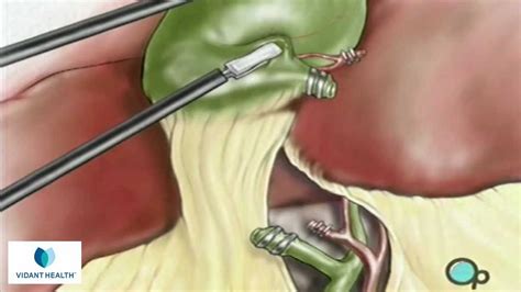 How To Remove A Gallbladder Laparoscopically
