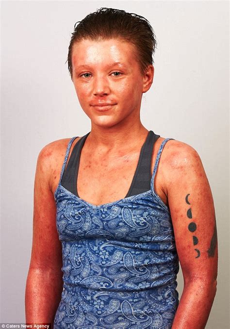 Eczema Sufferer Left Looking Like A Lobster After Reaction To Steroid